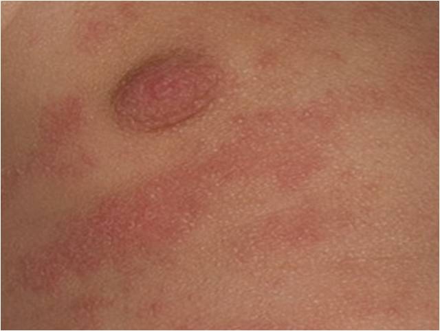 Ringworm Pictures: How To Identify Ringworm On Your Body ...