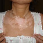 Vitiligo2